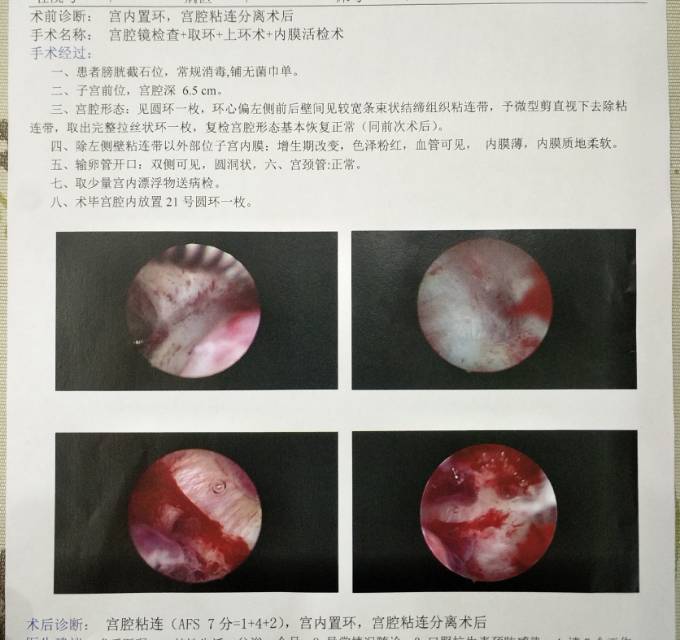 症状描述宫腔粘连末次月经810821宫腔镜宫
