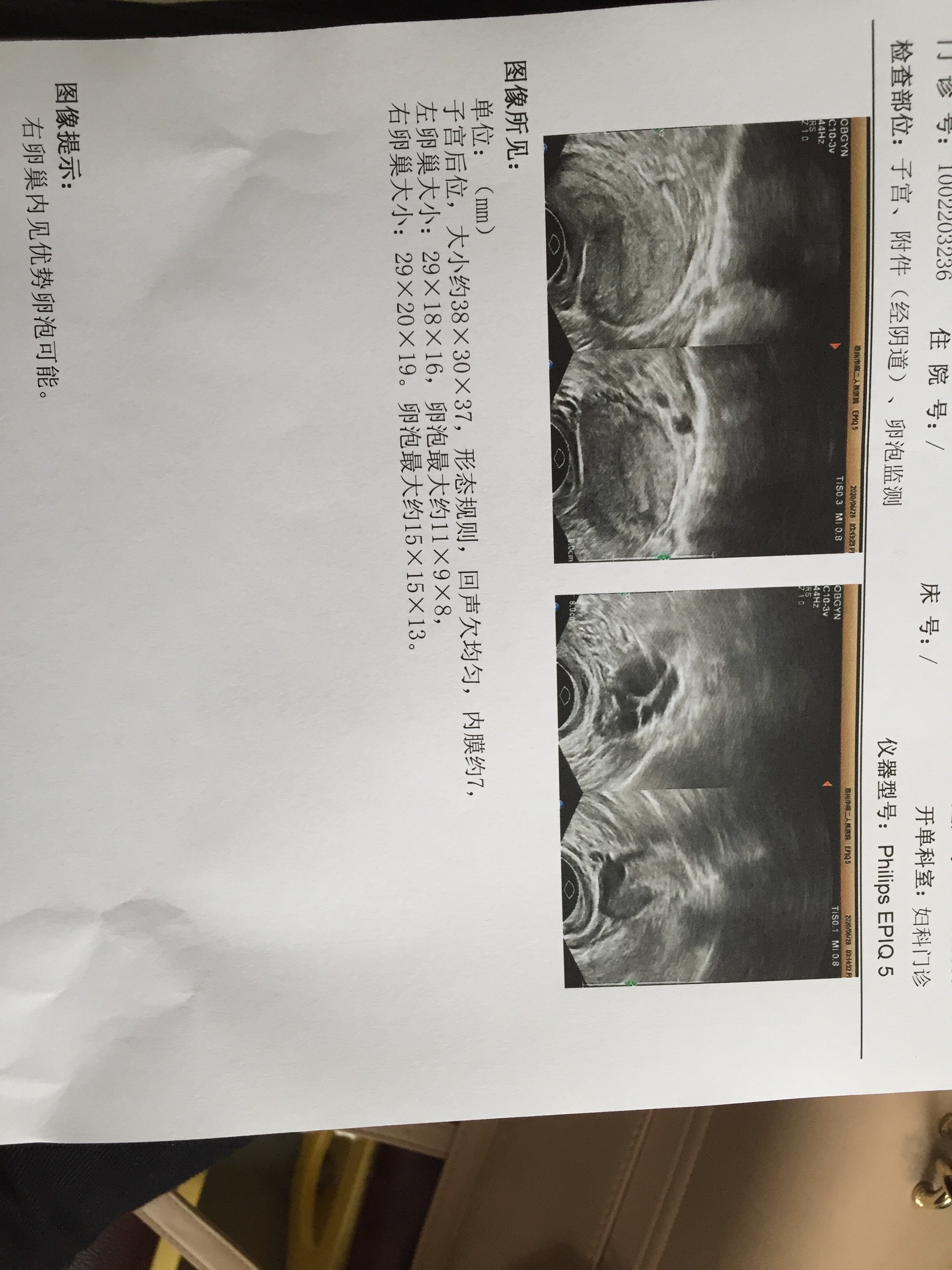 29岁备孕一年多发现每次去医院检查排卵情况要