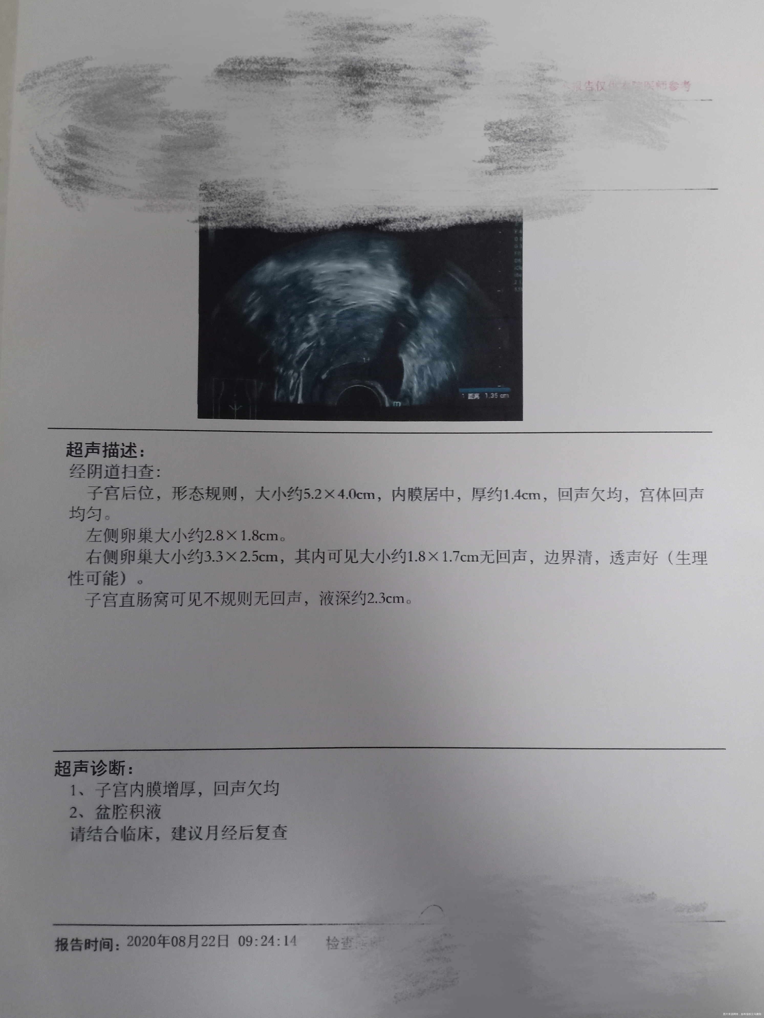 医生您好我是试管病人准备移植因例假周期准确而