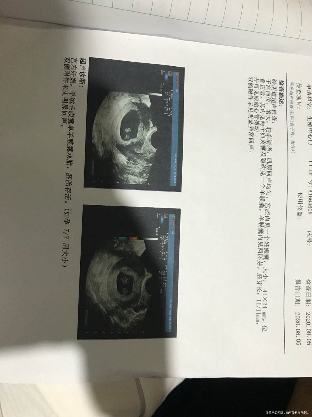移植有30天一个囊胚现在B超照出宫腔内见一个