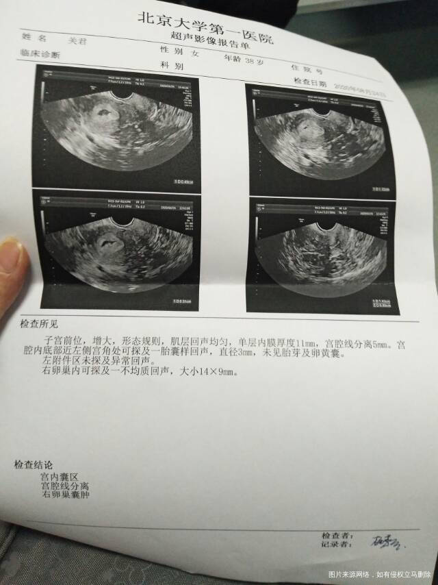 您好末次月经7月17今天拍B超有囊肿以前拍B