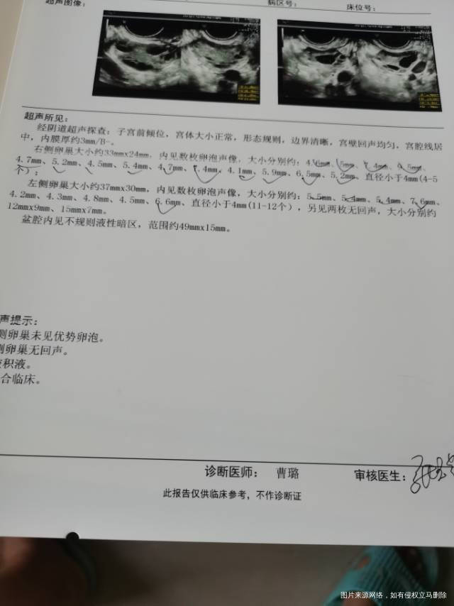 做试管降调7月8号打了达必佳后卵巢过度刺激长