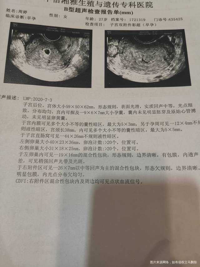 8月17日B超0403内膜21hcg2100