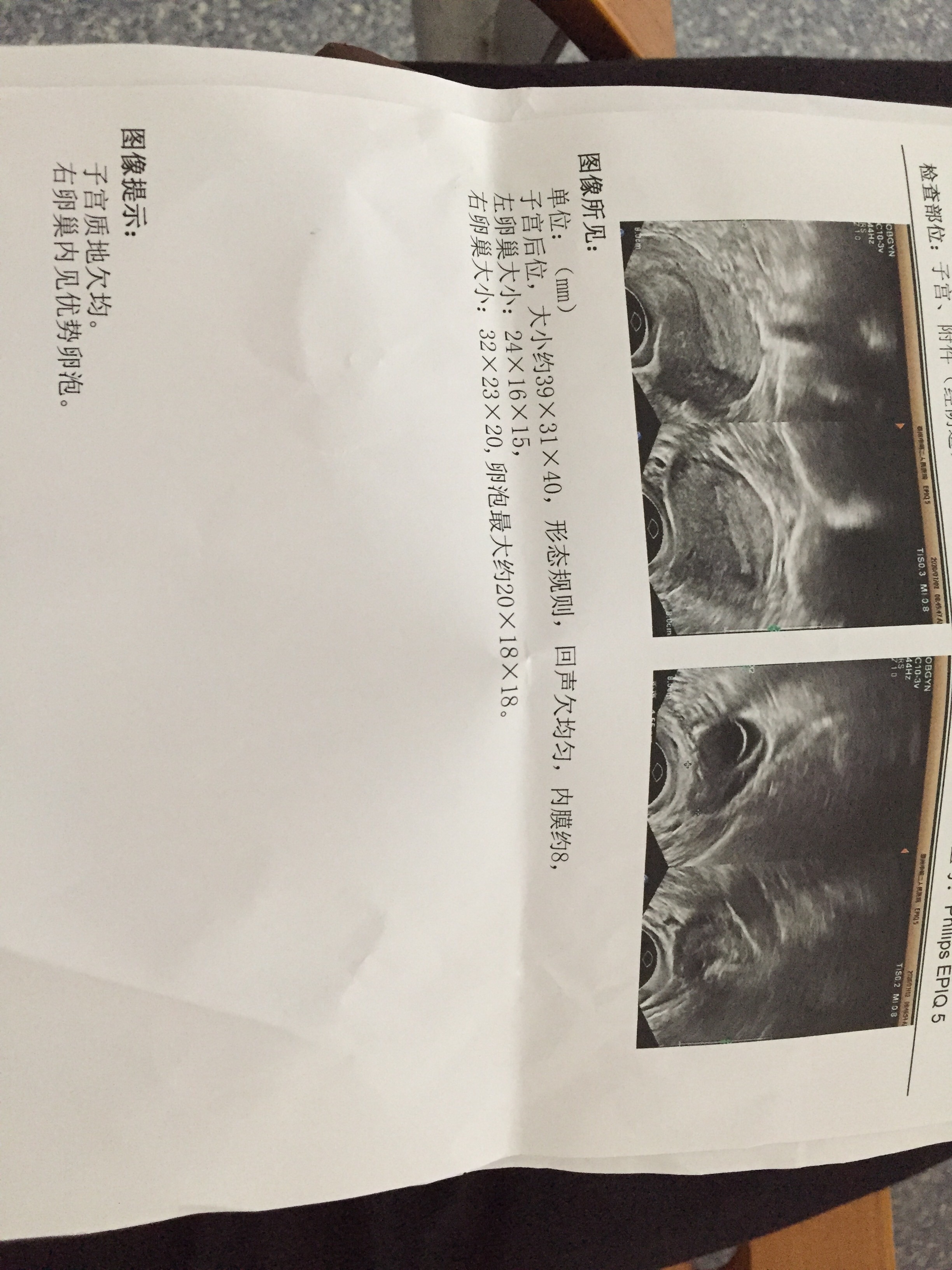 29岁备孕一年多发现每次去医院检查排卵情况要