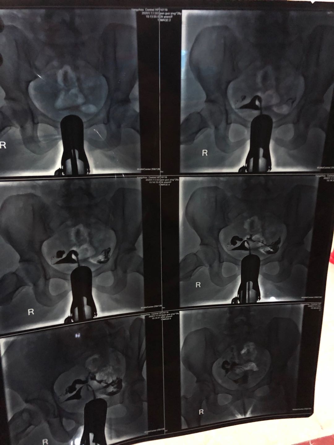 2月份做了宫外孕手术最近做了输卵管造影备孕的