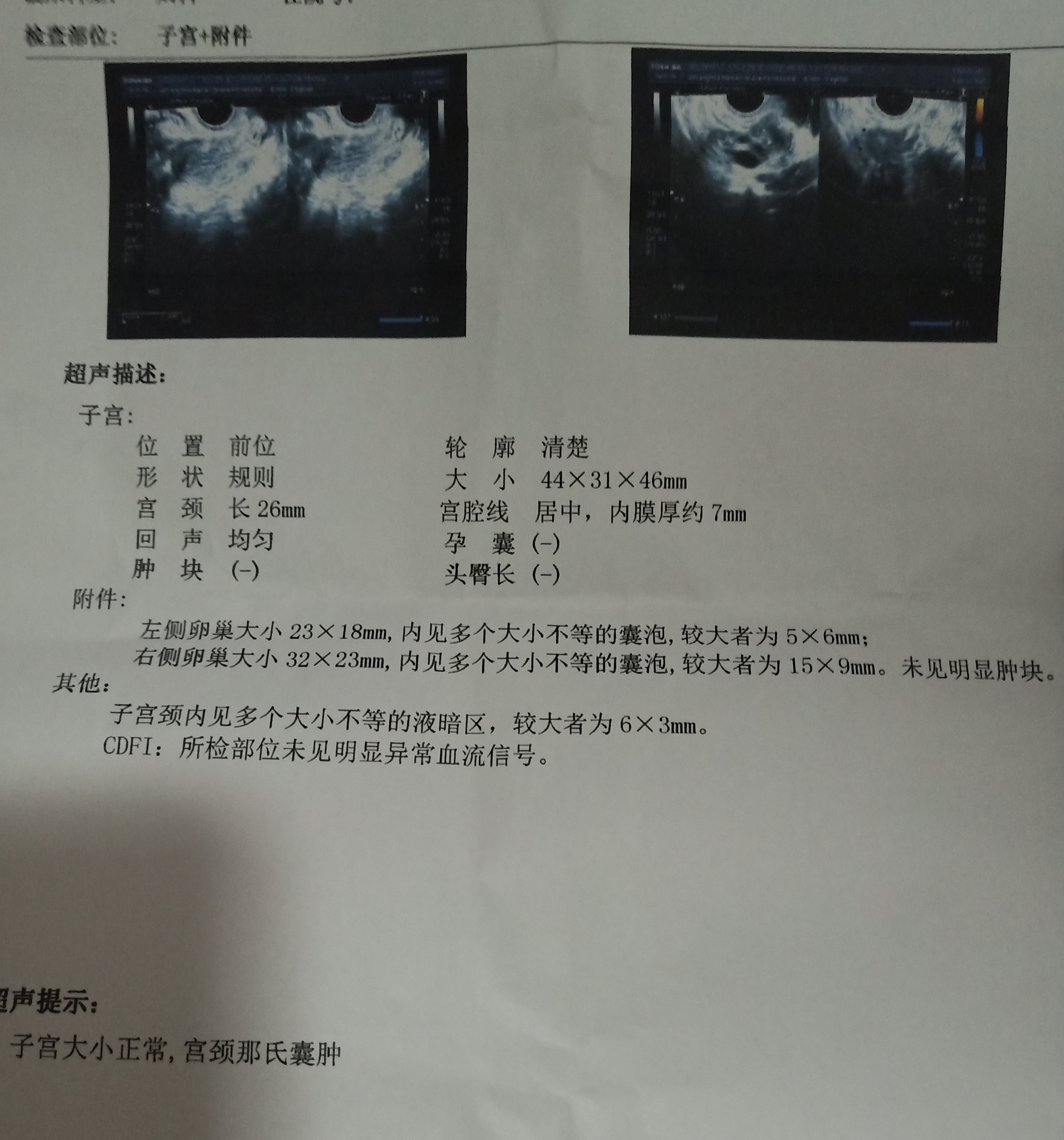 第一张是月经第十天做阴超测排卵报告第二张是第