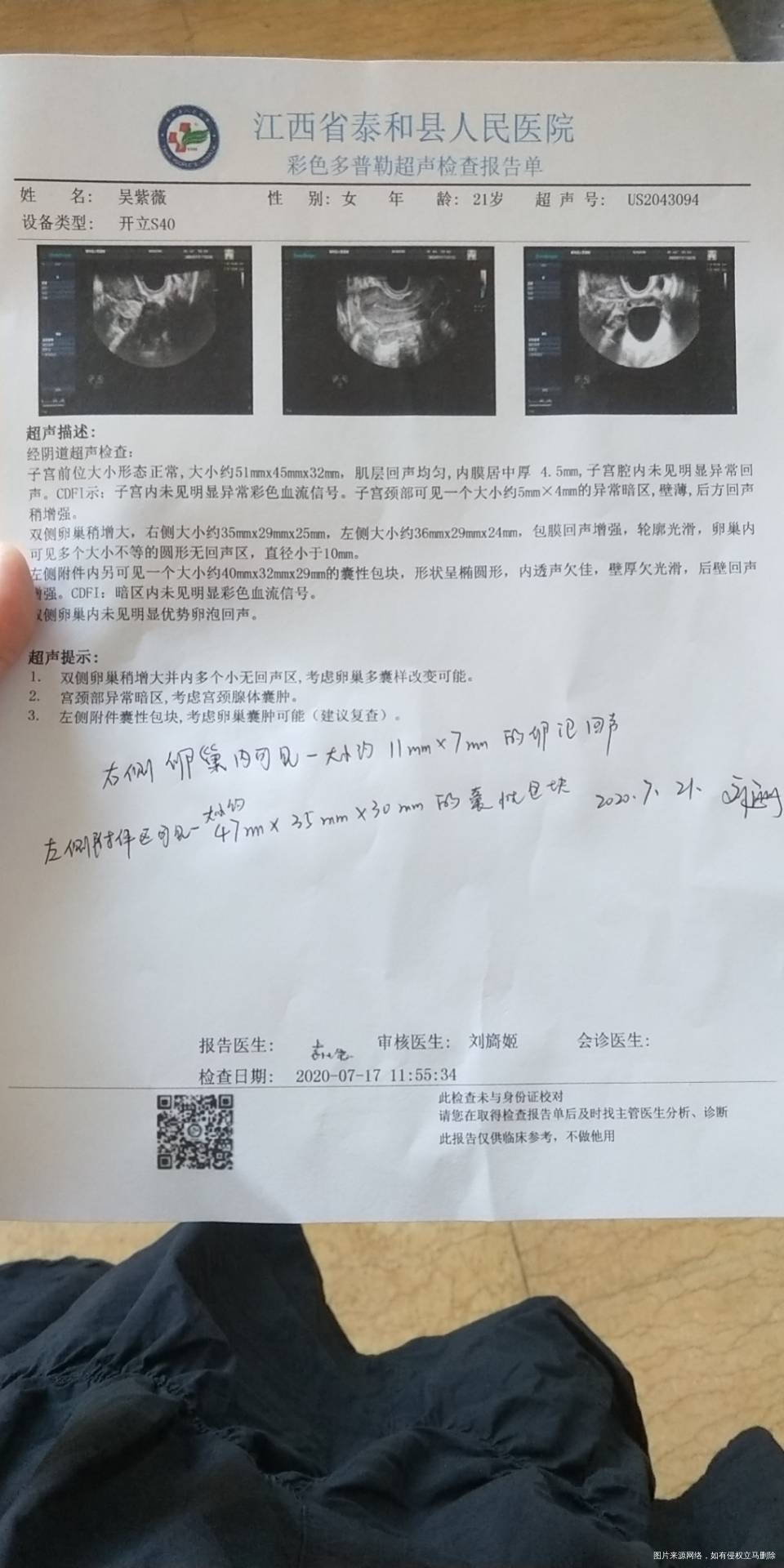 三年前诊断多囊服用达英35一年断药一个月怀孕