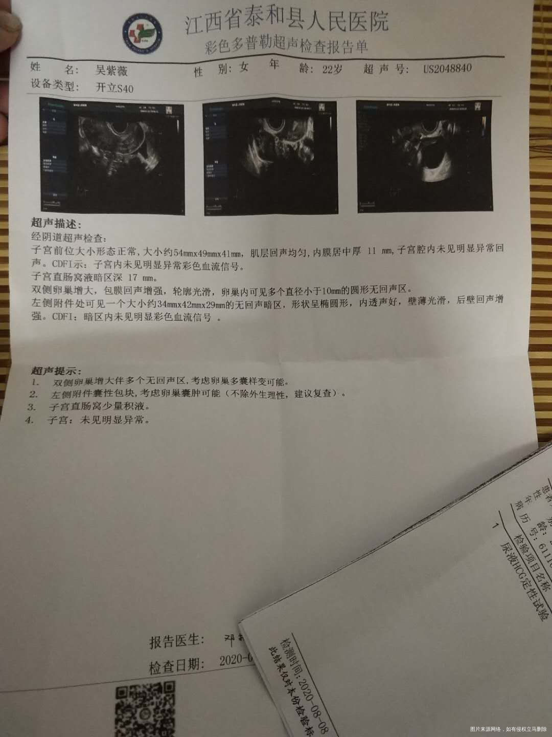 三年前诊断多囊服用达英35一年断药一个月怀孕