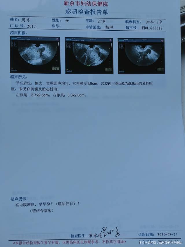 8月17日B超0403内膜21hcg2100