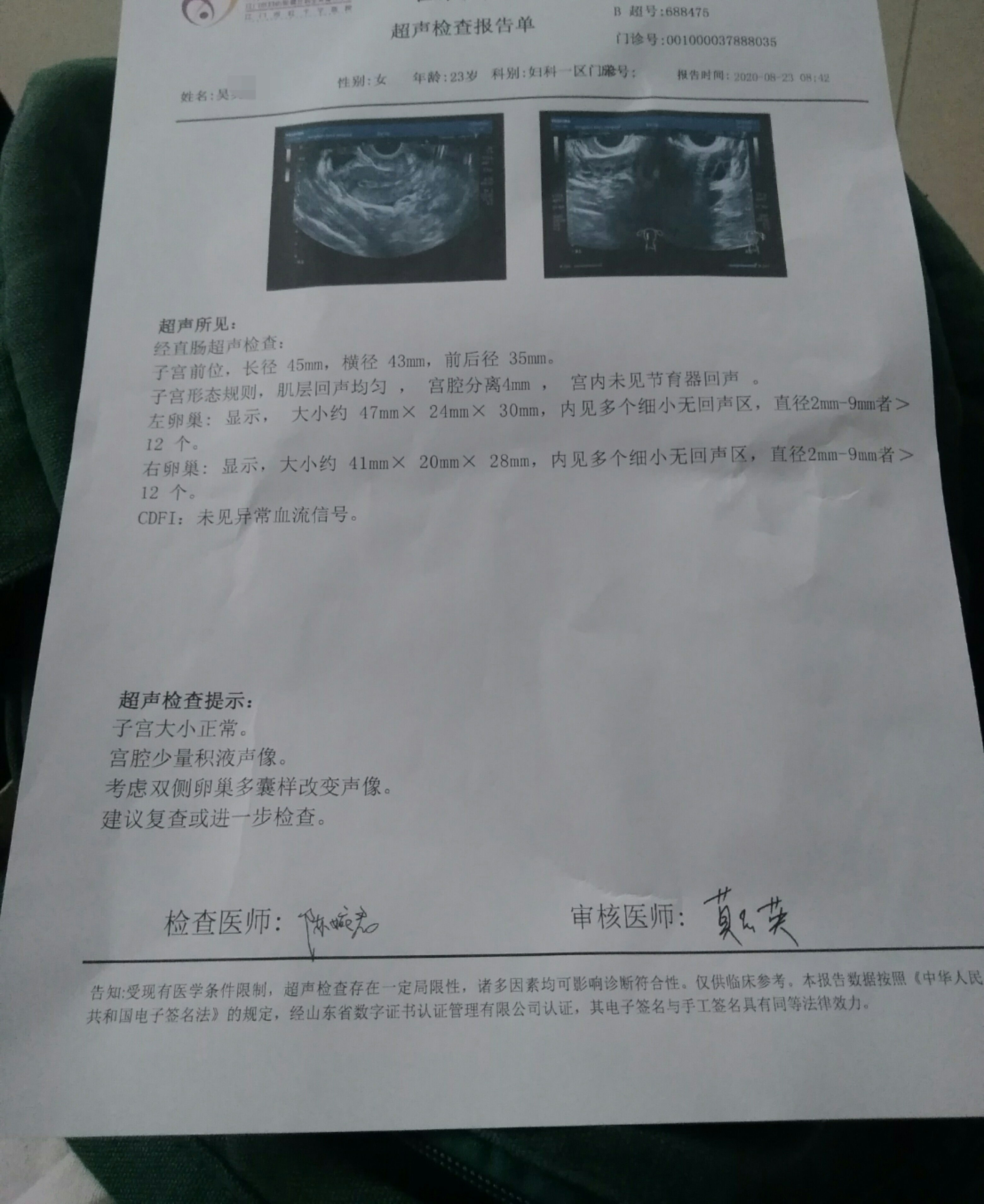 医生您好我超声检查提示说考虑双侧多囊卵巢样改