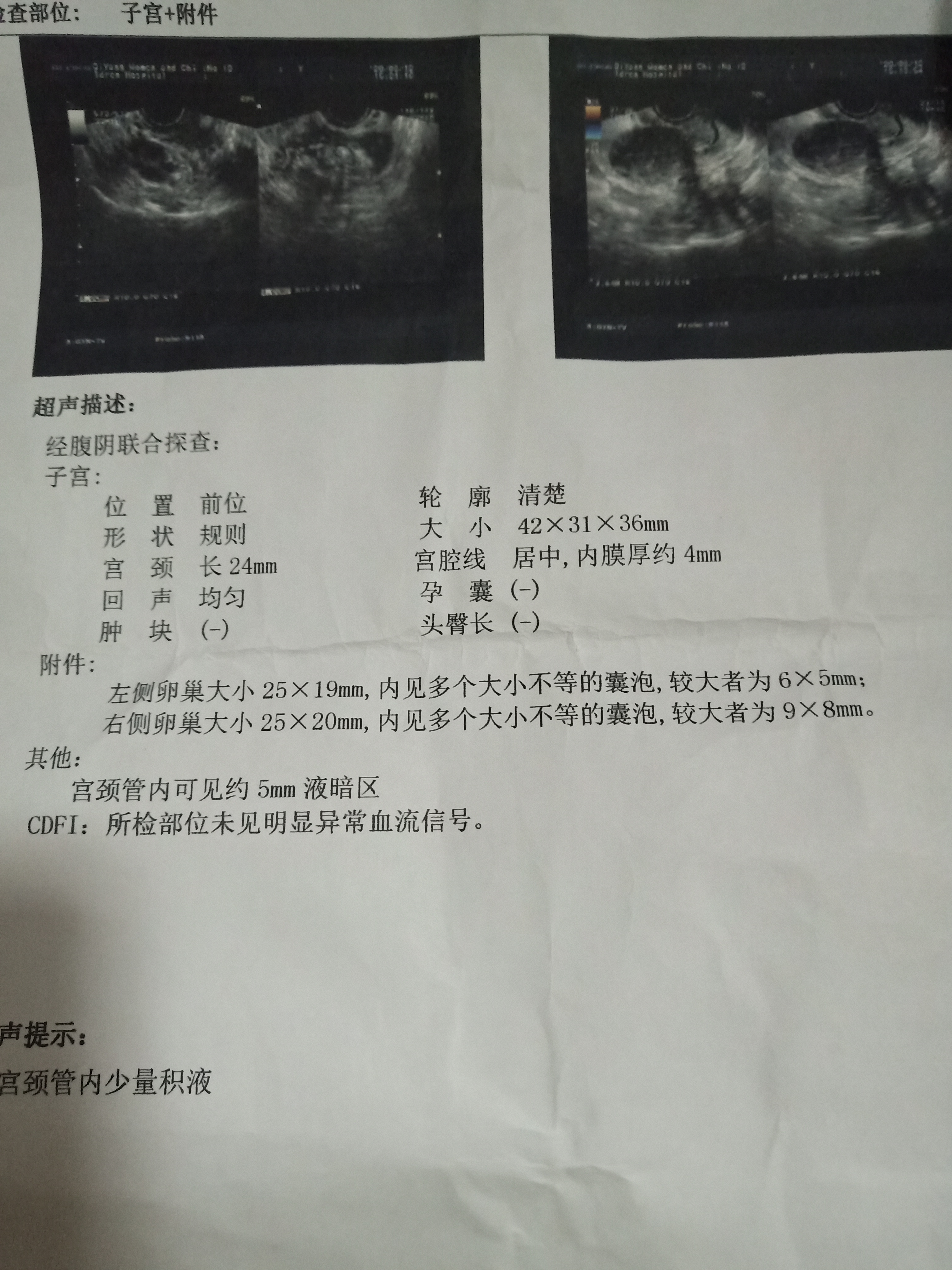 第一张是月经第十天做阴超测排卵报告第二张是第