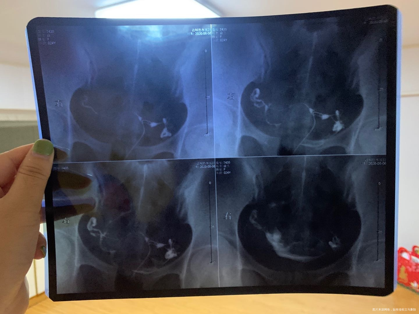 请问一下我这样情况输卵管算严重的嘛我没怀过孕