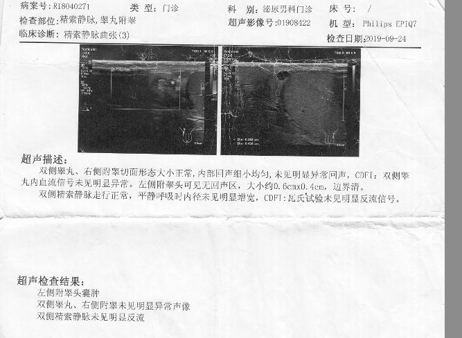 您好医生我老公十七八岁在小县城做过左精索静脉