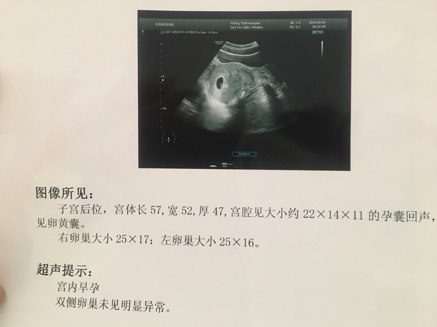 医生你好末次月经72691号查出怀孕孕酮97