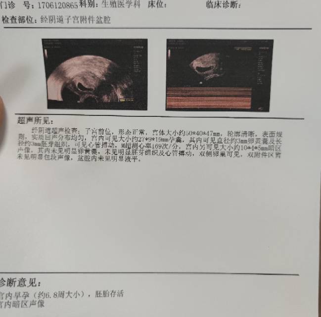 811移植两枚8细胞的冻胚97号28天做第一
