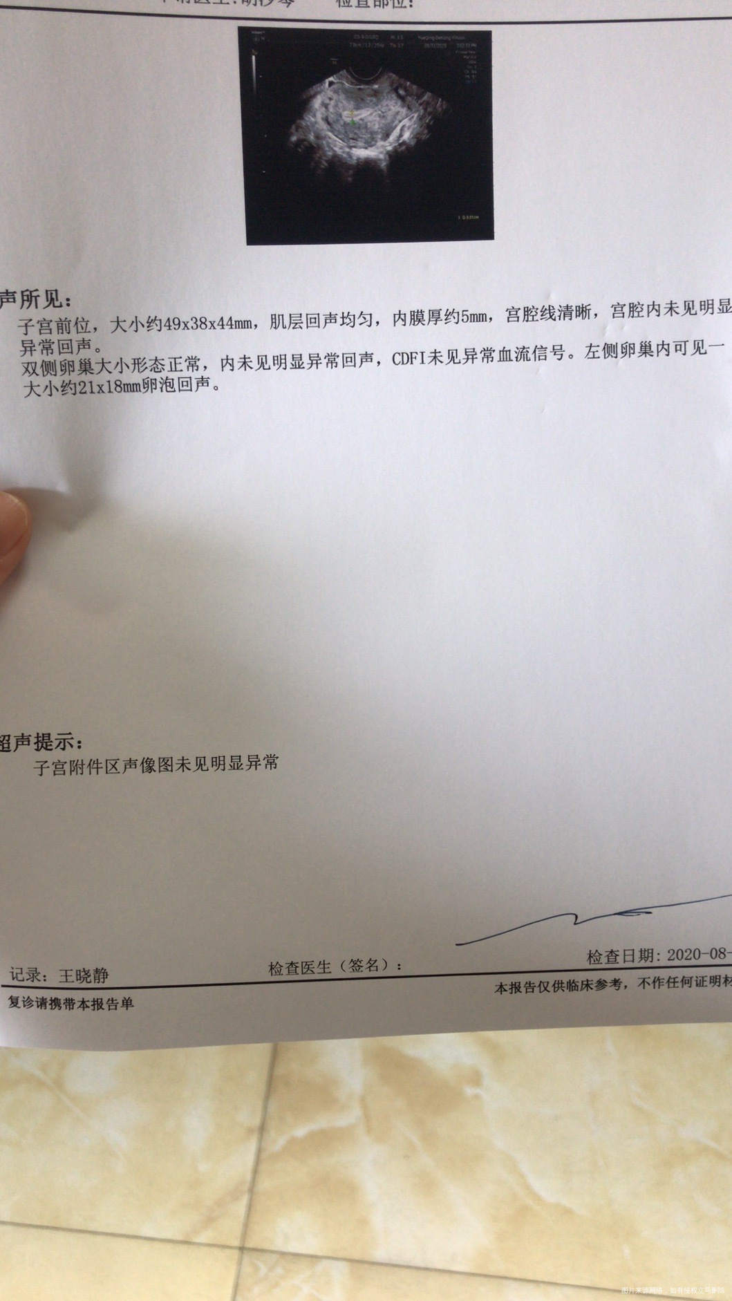 月经第15打的B超内膜5mm第20天打的B超