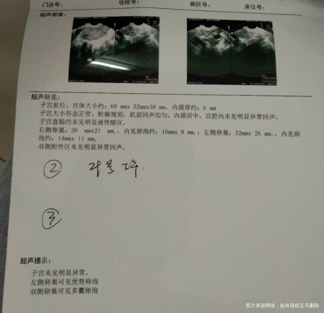 现在在治疗多囊想问一下多囊好了之后可以怀孕吗