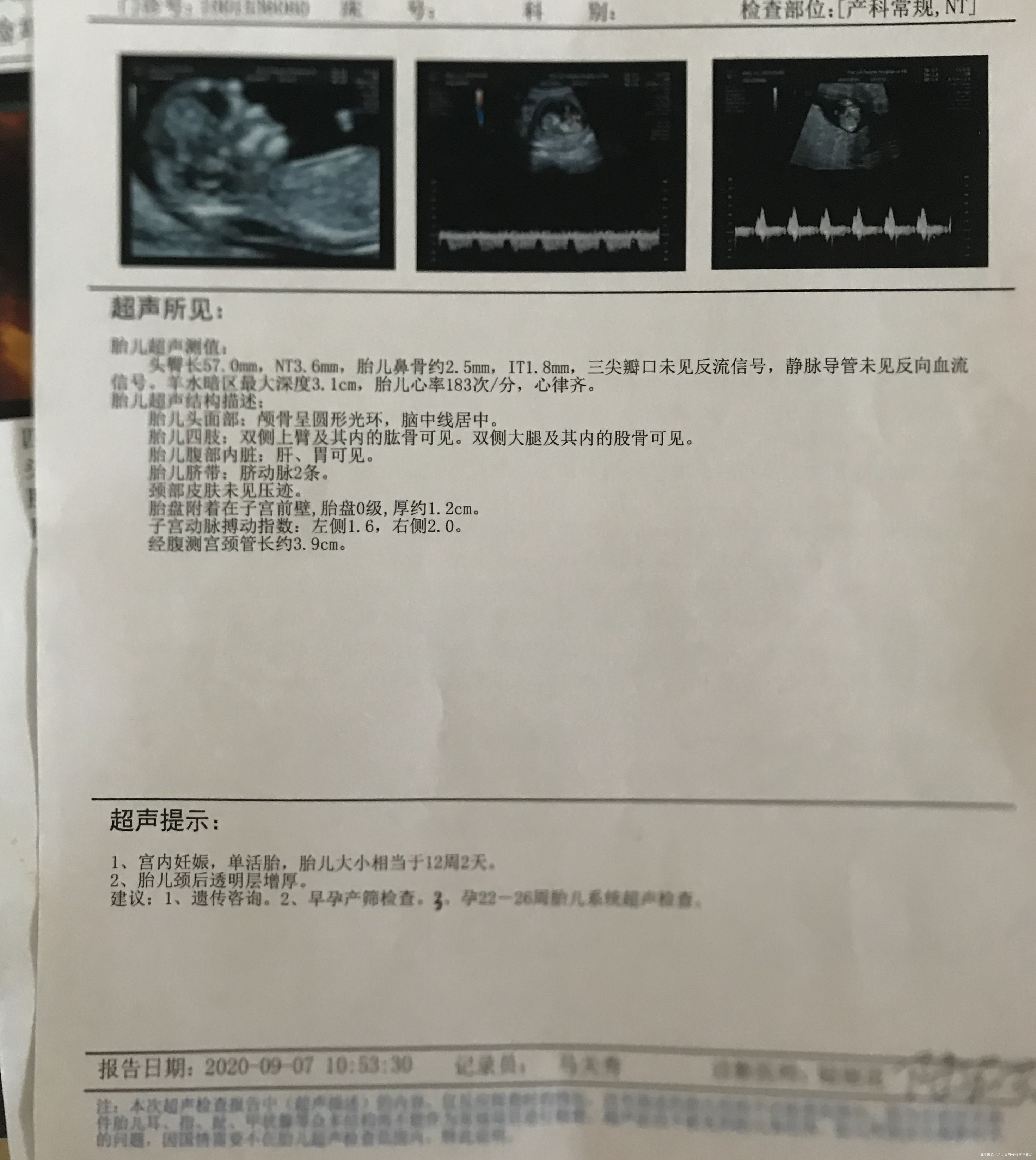NT偏厚看得见鼻骨这样是不是就可以排除唐氏综