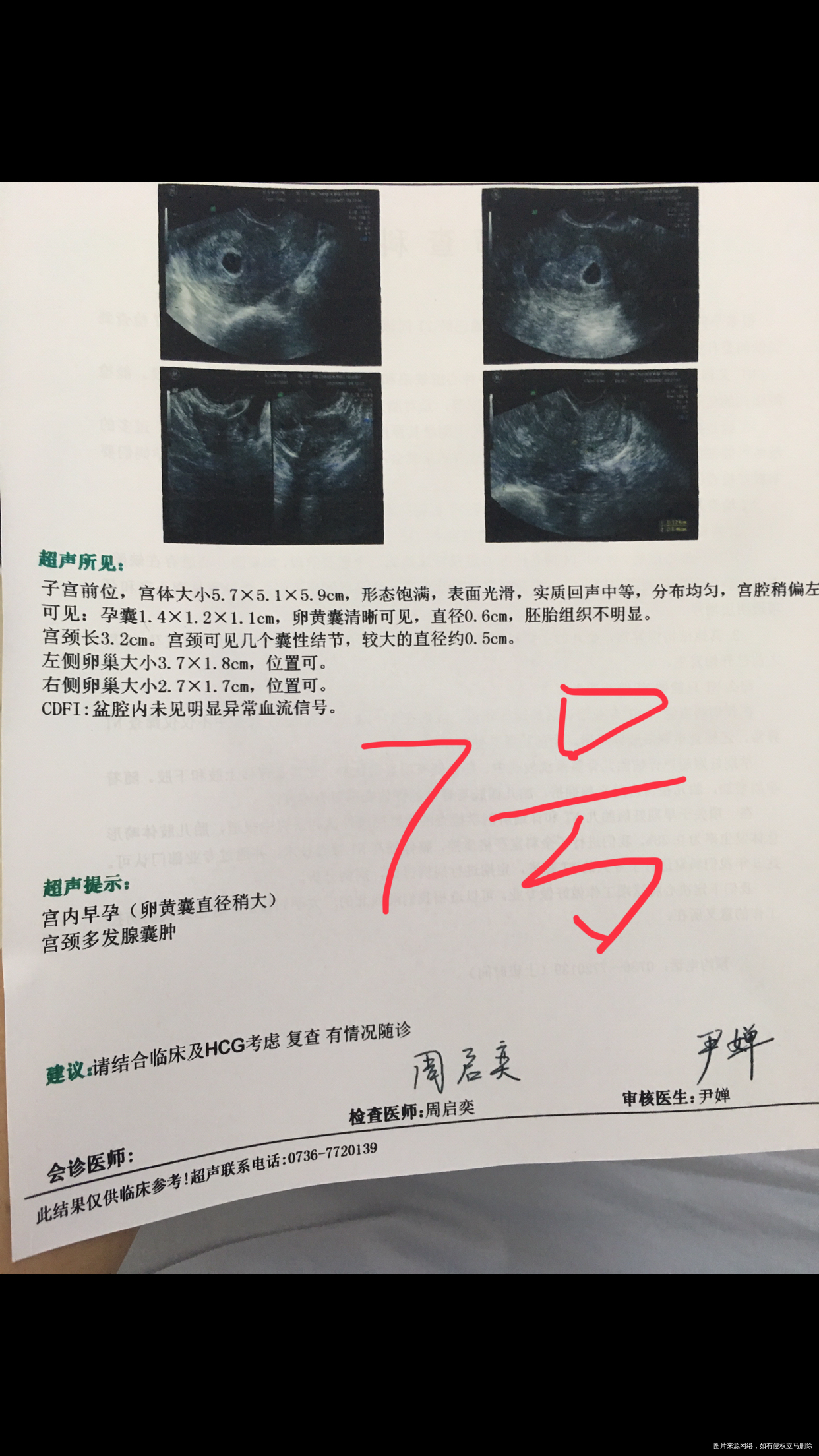 医生您好我8月8号移植两枚五天的4bc囊胚1