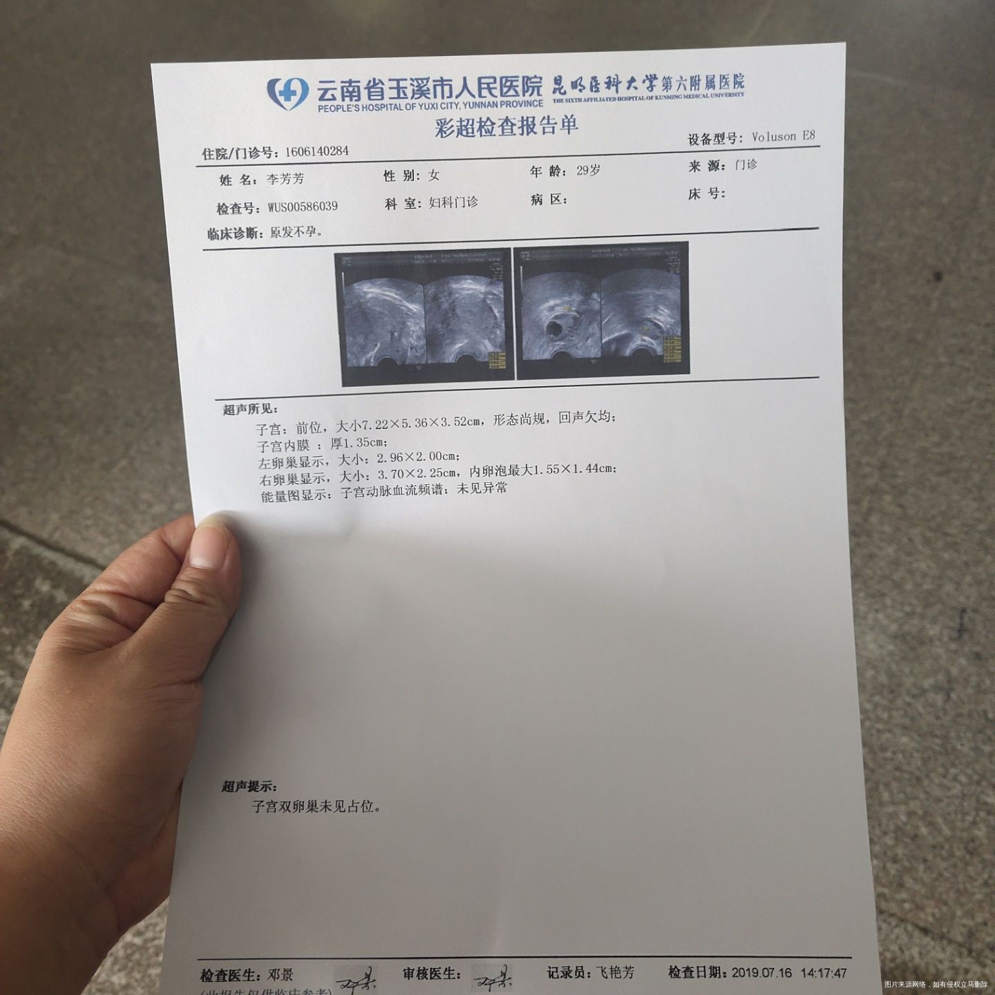 结婚4年一直未避孕婚后三年女方做过多囊卵巢囊