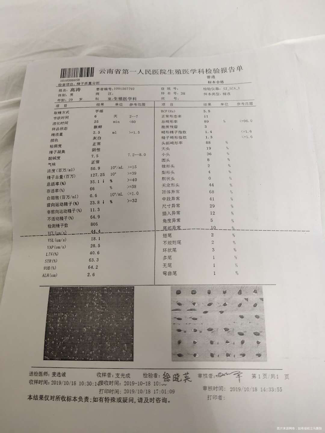 结婚4年一直未避孕婚后三年女方做过多囊卵巢囊