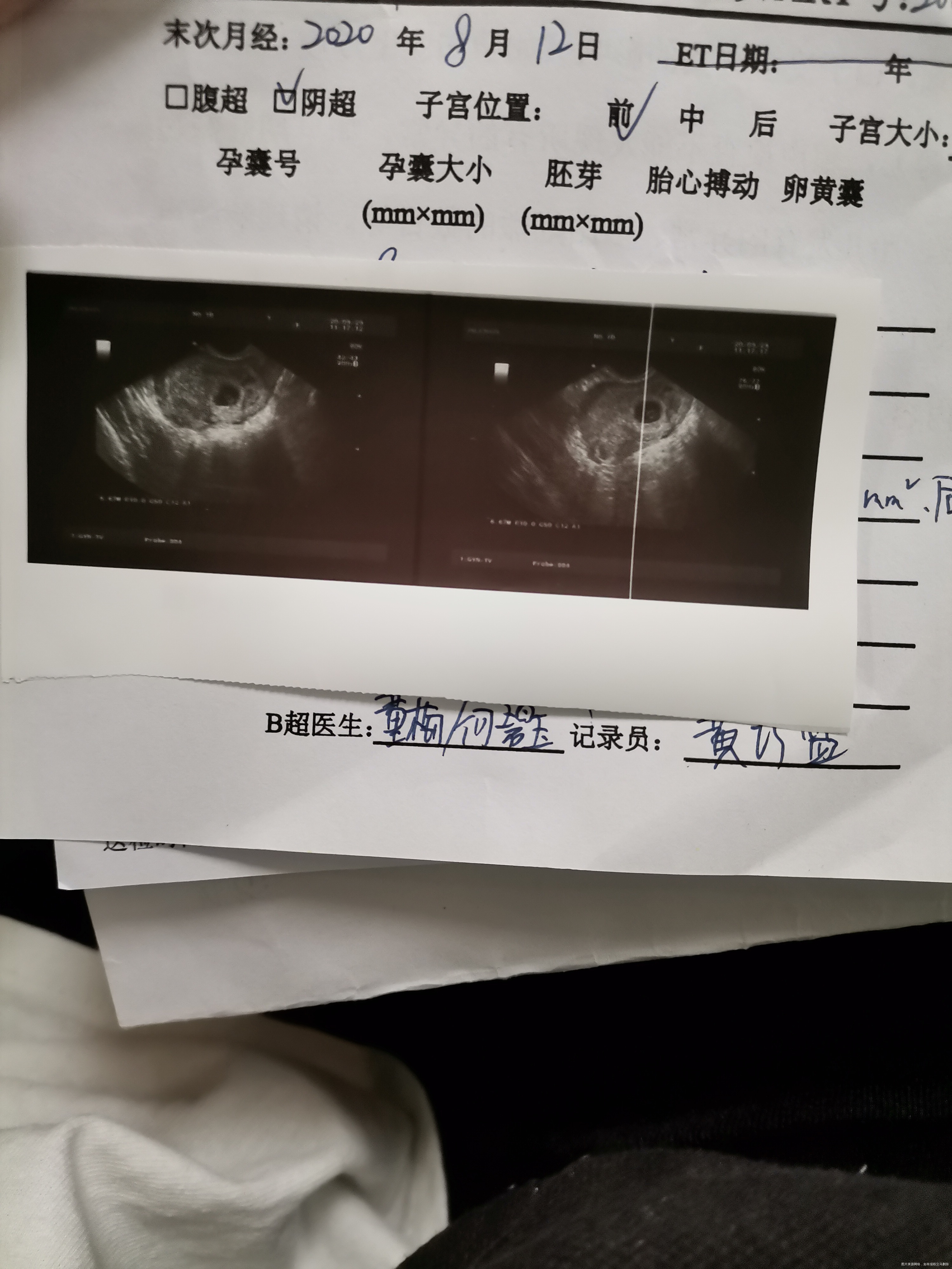 孕6周+6检查有了胎心胎芽请问这个宫腔内不规