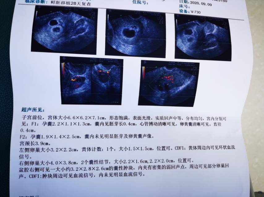医生您好我8月13日移植鲜胚3bc和4bc两