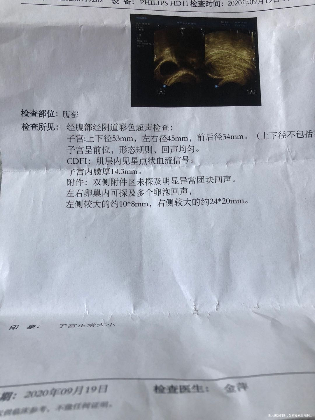 左侧输卵管通畅右侧积水不通但是右侧优势卵泡排