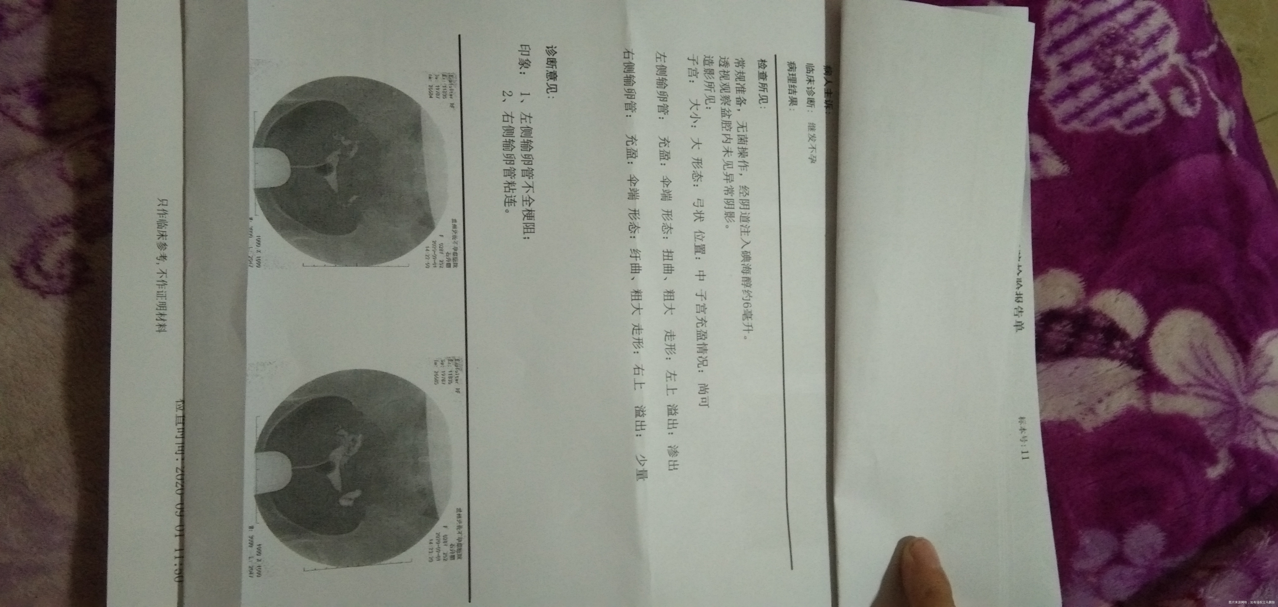 医院检查报告出来了这个病症的关键是不是在输卵