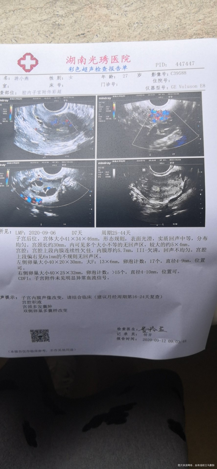 医生您好这个报告单可以看出有宫腔粘连问题吗问