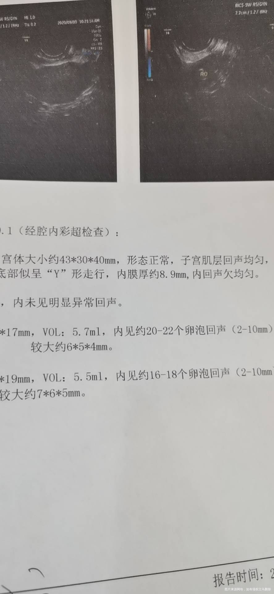 月经第三天的B超单内膜涨了卵泡怎么没有跟上呀