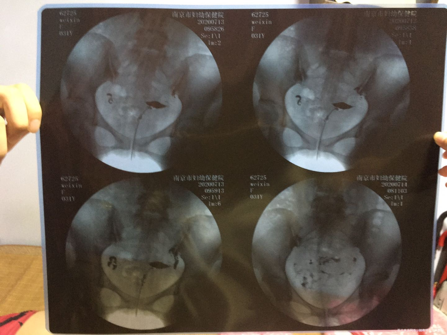 医生您好1AMH1247ng/ml孕酮未测其