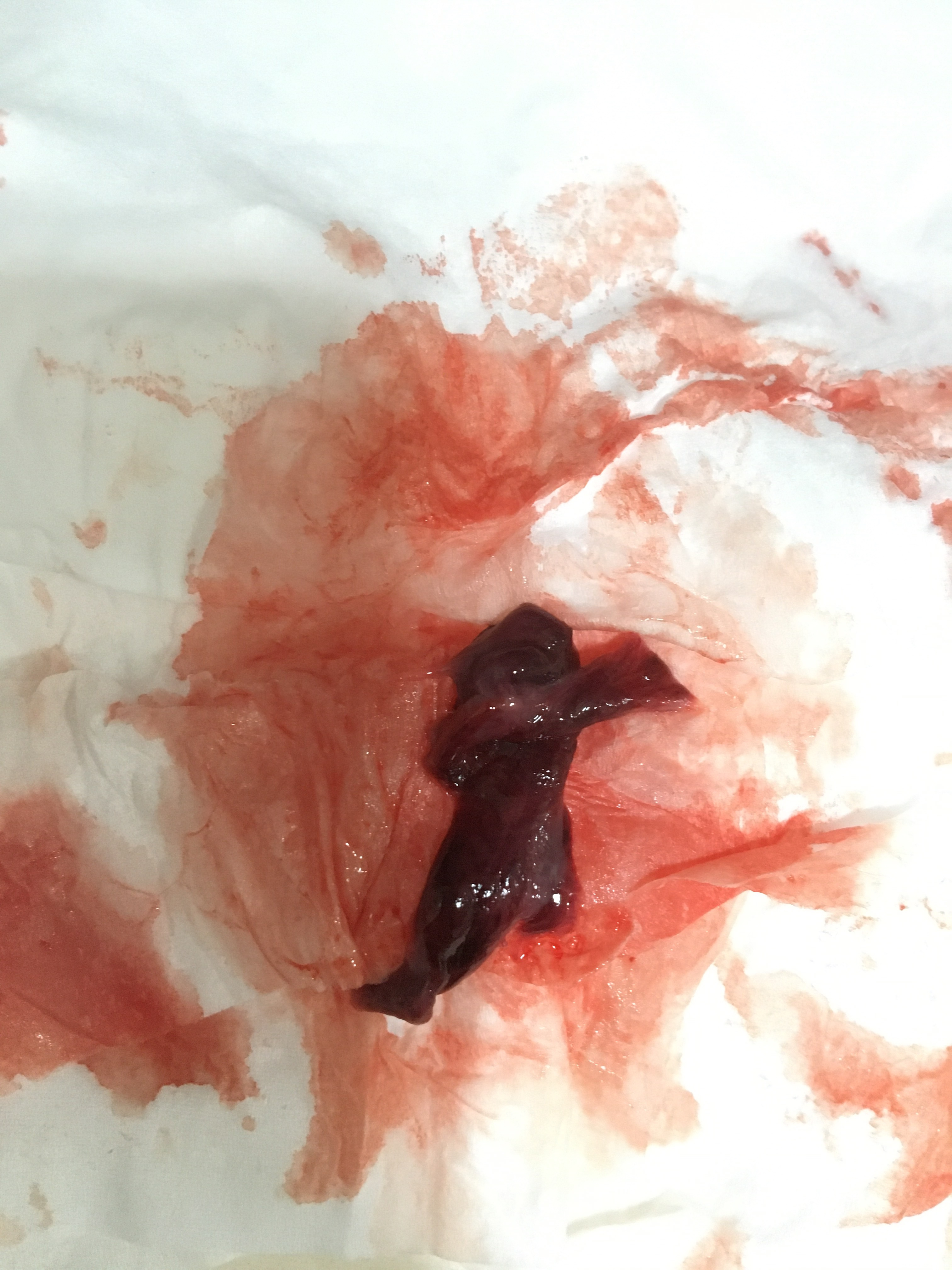 月经周期不规律容易推迟来月经的时候会排出烂肉