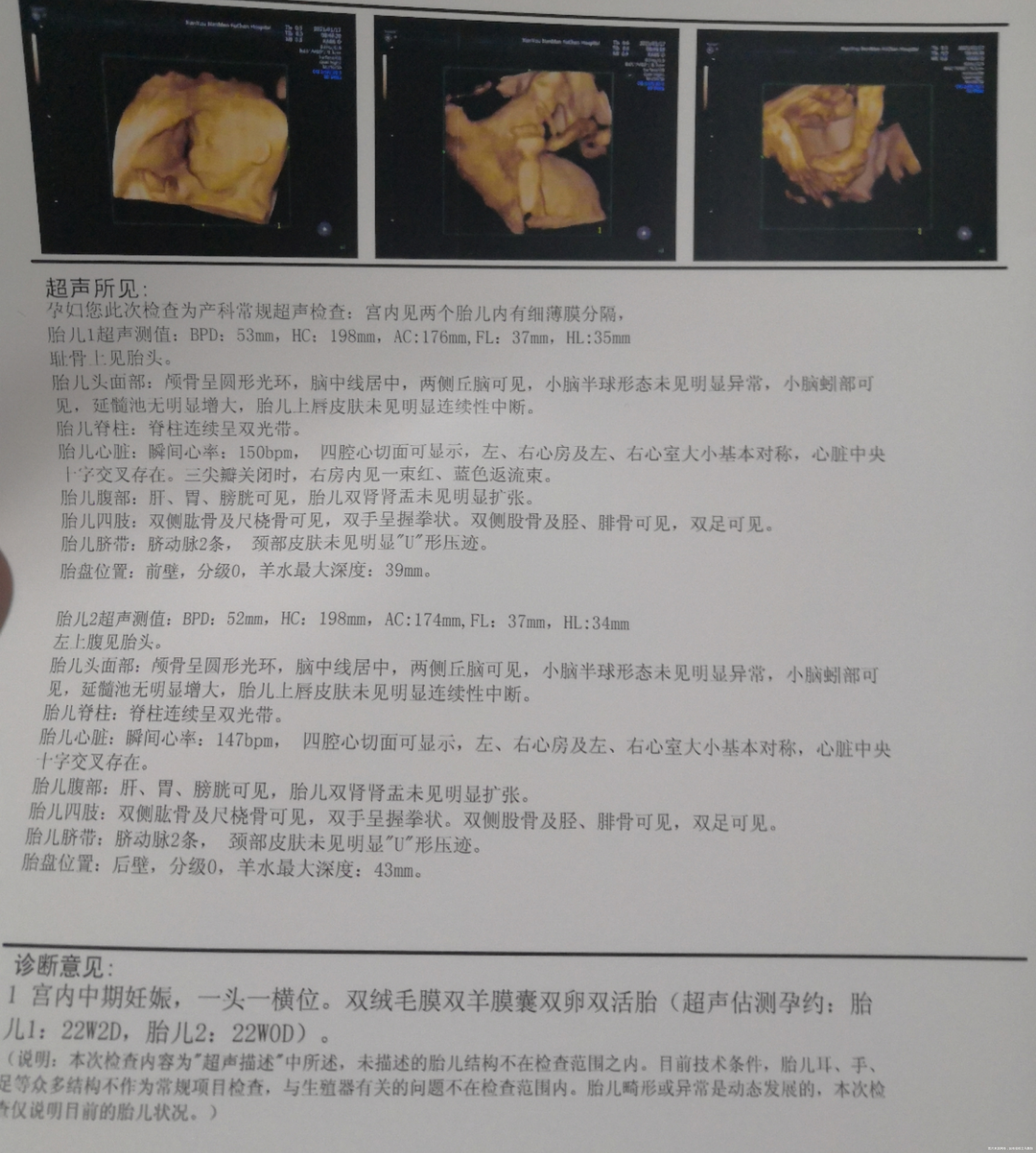 之前多囊促排怀孕外婆有双胞胎史目前双胞胎双绒