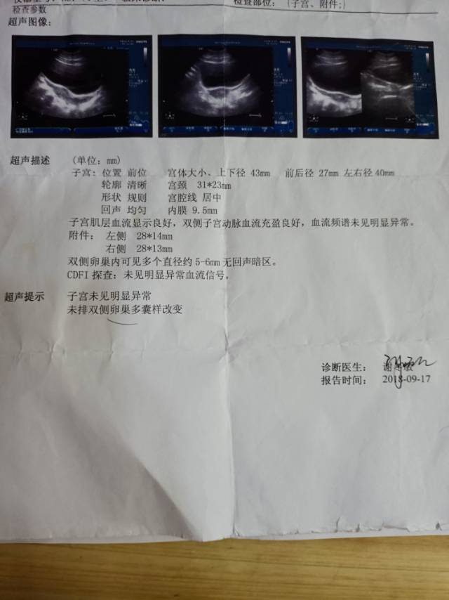 医生您好我今年20岁多囊目前体重126斤在三