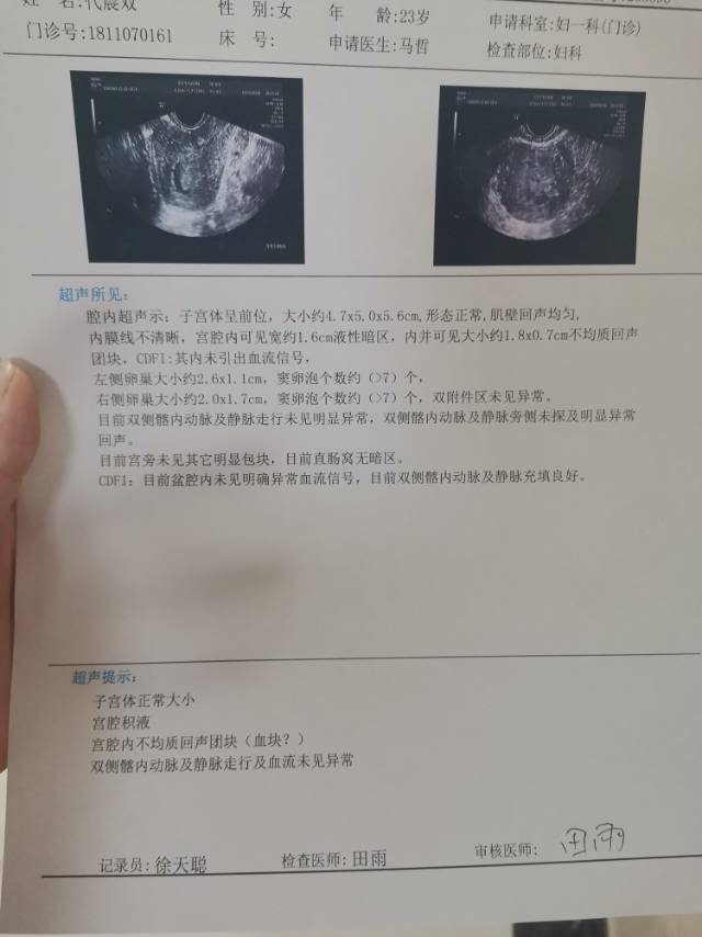 1月11号做的无痛人流一个星期后复查没流干净