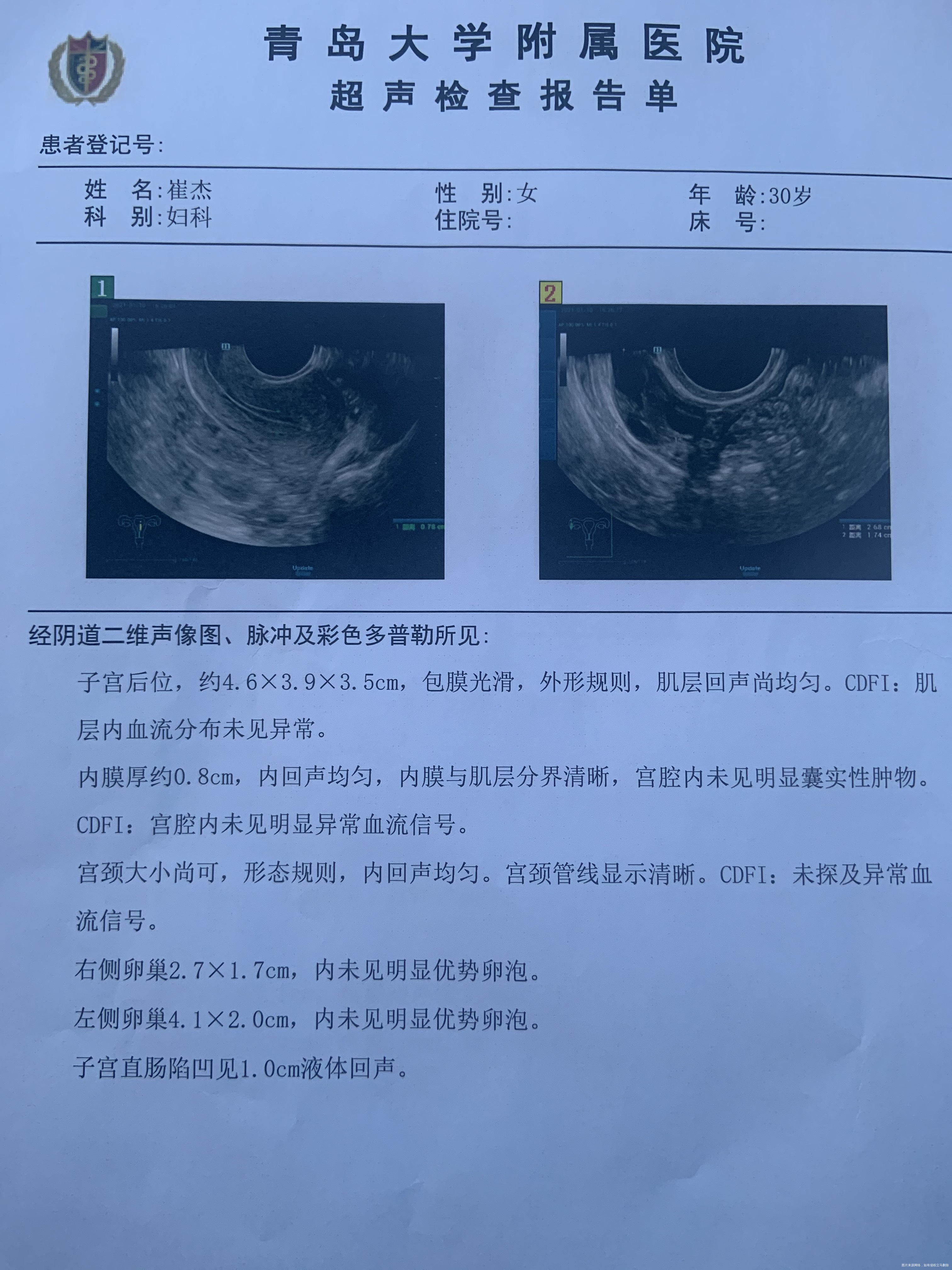 促排卵治疗月经周期第12天测卵泡19✖️15