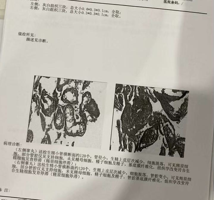 医生您好请问睾丸穿刺这样的结果还有生育希望吗