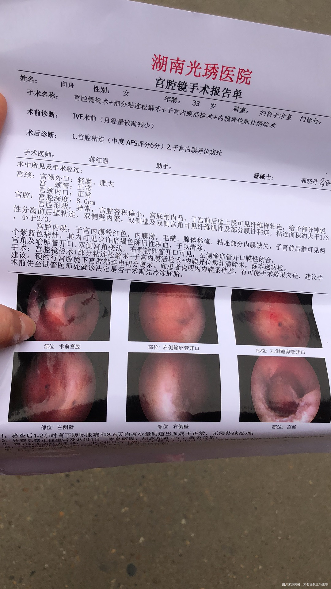 清宫后三个月宫腔镜检查粘连6分咨询最佳手术时