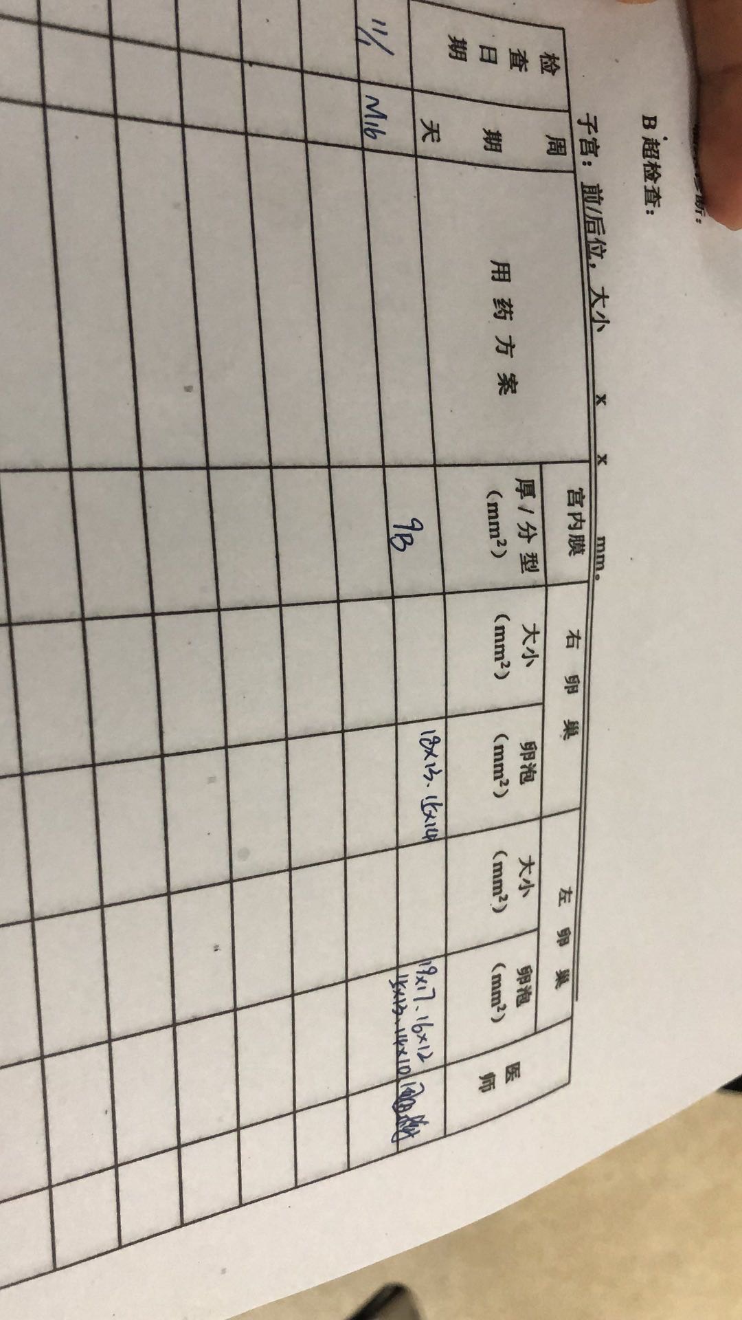 你好我想问下医生在我卵巢增大时给我用了泼尼松