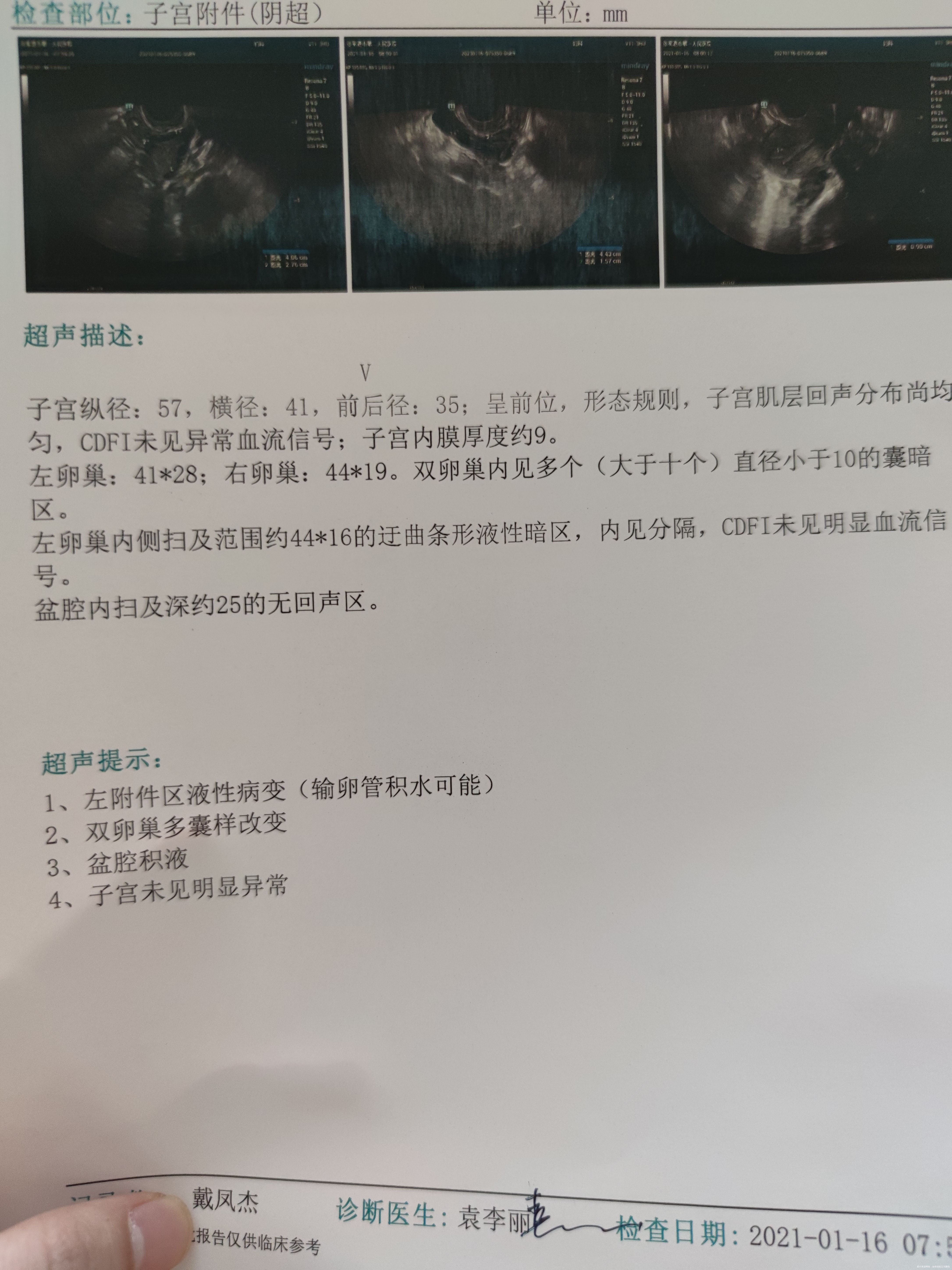 医生你好我有多囊2019年10月检查出多囊吃