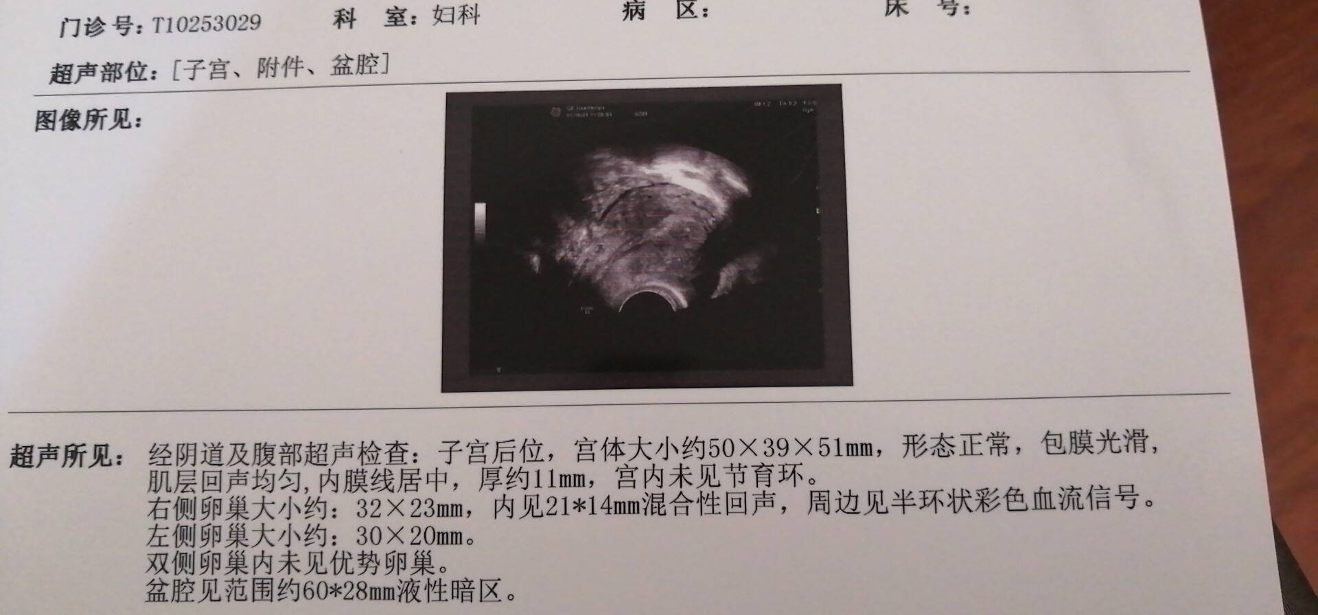 右侧卵巢内见2114mm混合性回声周边见半环