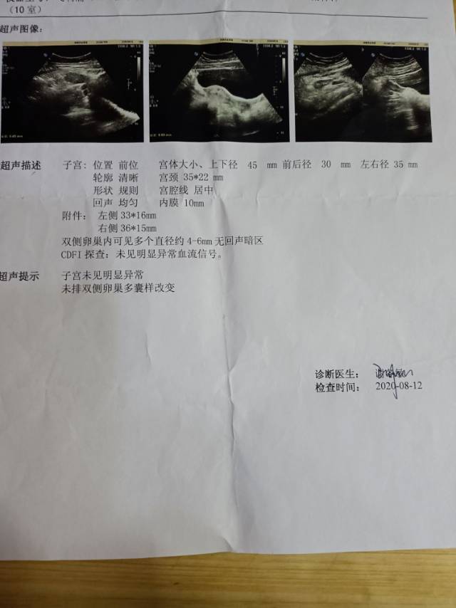 医生您好我今年20岁多囊目前体重126斤在三