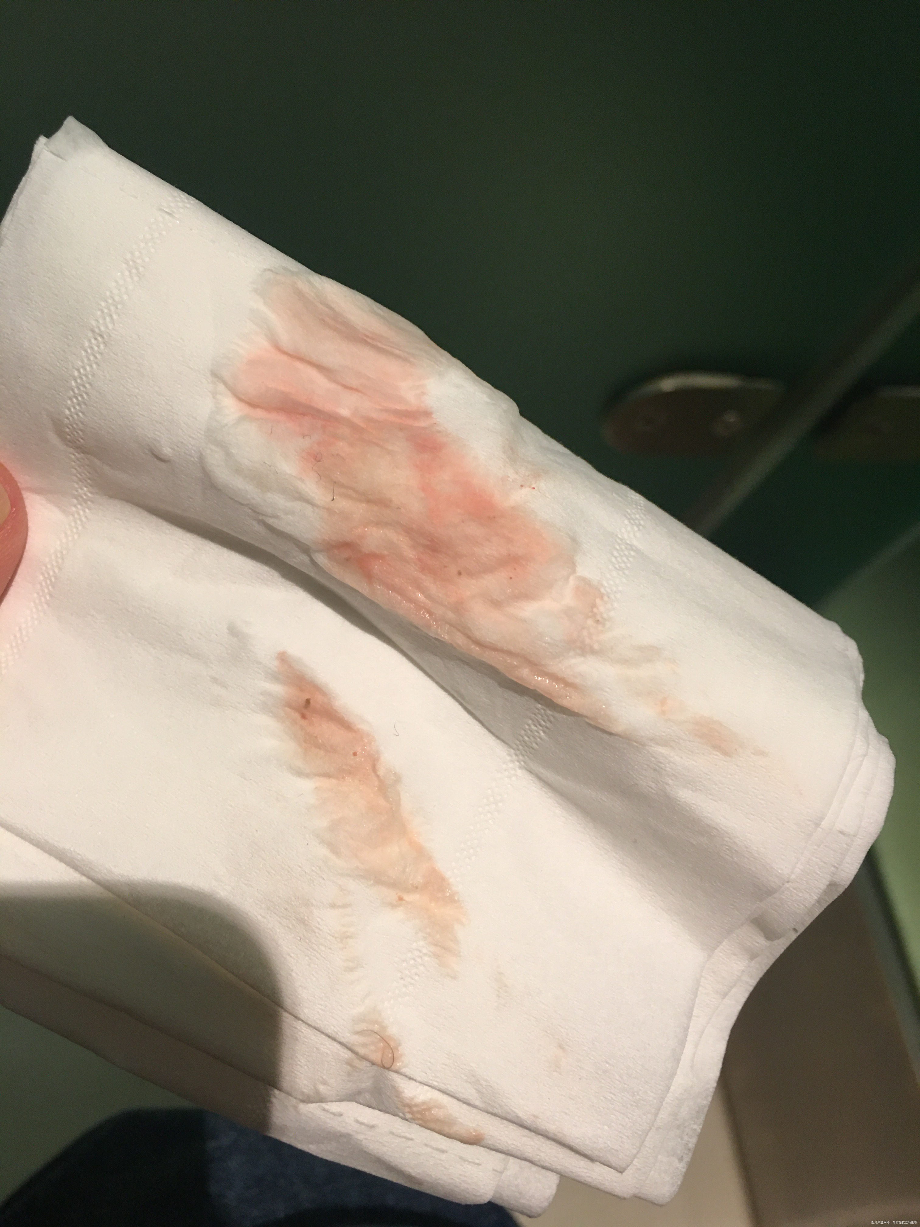 医生我试管早孕7周现在每天用雪诺酮口服孕酮片