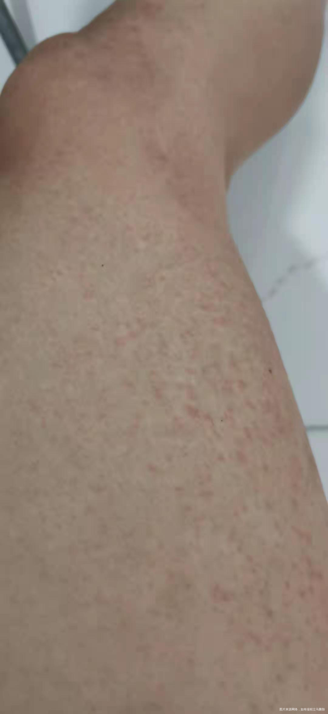 你好请各位生殖科医生帮忙瞧瞧我老公湿疹能吃附