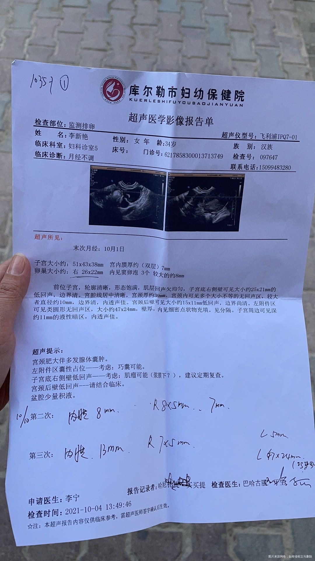 7月促排取卵5枚配2养囊失败今年35左侧巧囊