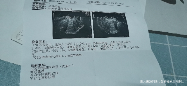备孕两年没有怀孕半年之前查了输卵管造影现在忽