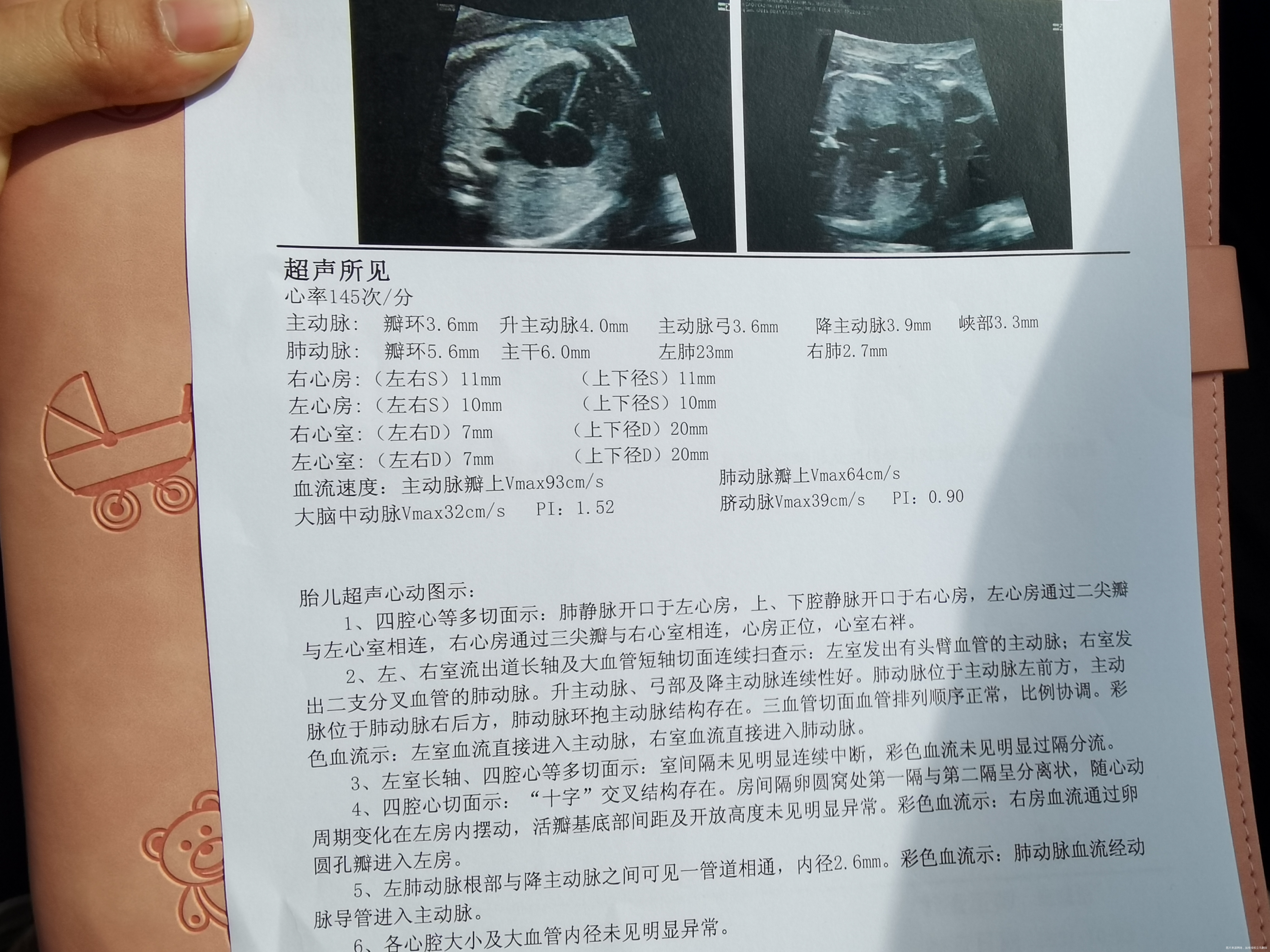 孕25周今天做了心脏超声医生建议四周后复查这