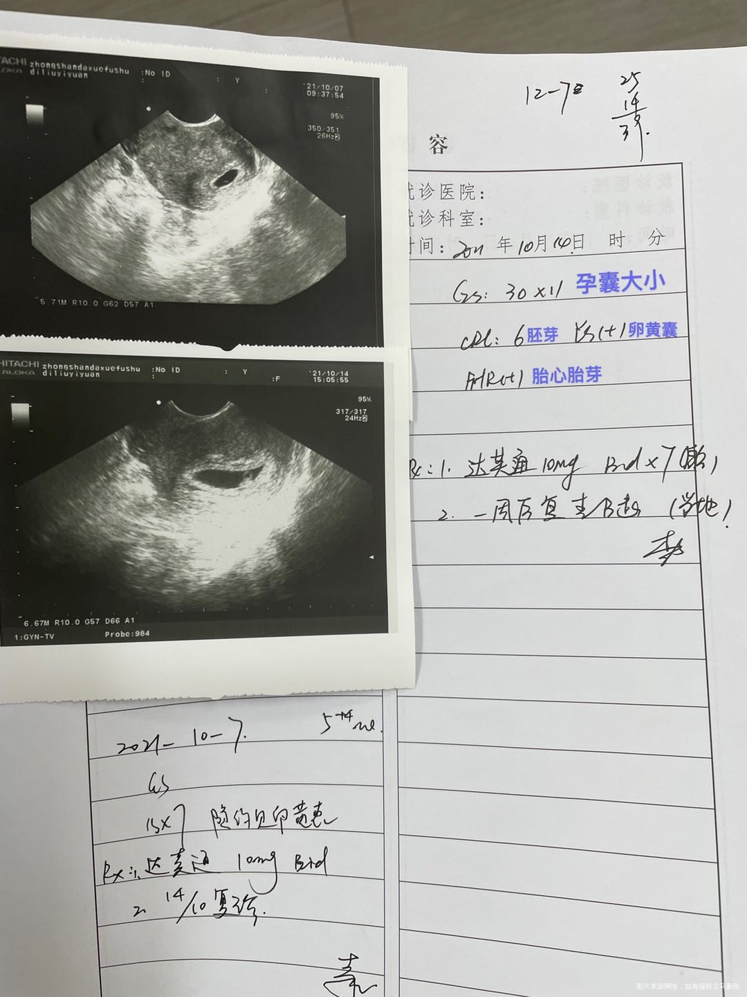 B超孕囊30×11mm胚芽6mm有胎心胎芽了