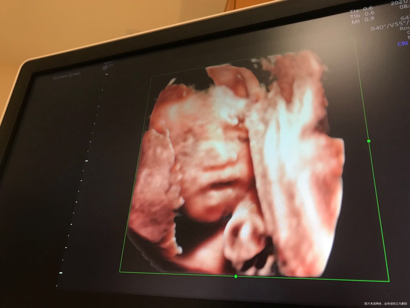 宝宝头上这是啥四维彩超医生说正常的